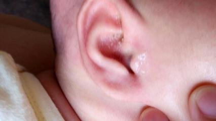 慢性化脓性中耳炎的鉴别诊断方法有哪些呢